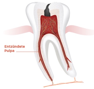 img endodontie step by step 1