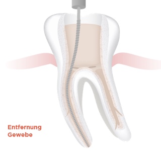 img endodontie step by step 2