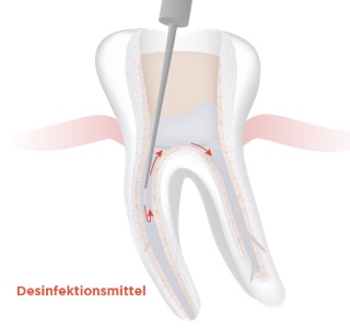 img endodontie step by step 3